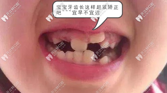 孩子牙齒錯(cuò)頜不齊真人效果圖
