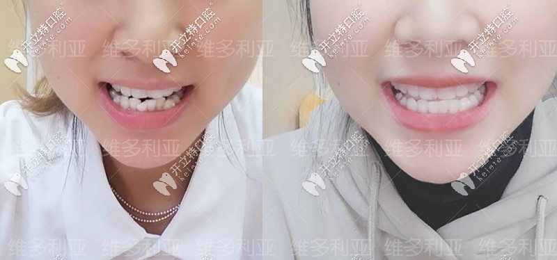 門(mén)牙外翻隱形矯正10個(gè)月前后對(duì)比
