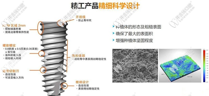 種植牙的六大特點(diǎn)