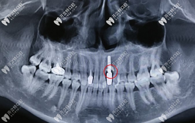 諾貝爾Active種植體可以預(yù)防種植牙骨吸收情況發(fā)生