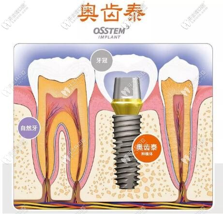 韓國(guó)奧齒泰種植體