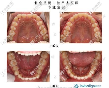 北京圣貝齒科呂杰隱形正畸案例前后對比 北京圣貝齒科呂杰隱形正畸案例前后對比