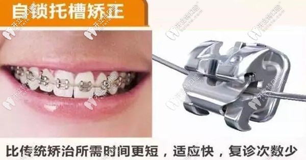 骨性齙牙做金屬自鎖托槽矯正