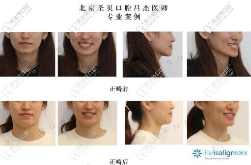 北京圣貝口腔呂杰醫(yī)師正畸案例 北京圣貝口腔呂杰醫(yī)師正畸案例