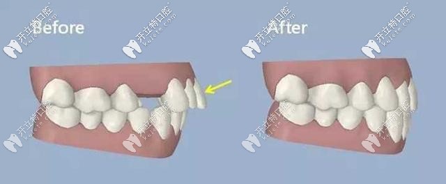 牙齒缺失通過矯正也可以解決 牙齒缺失通過矯正也可以解決
