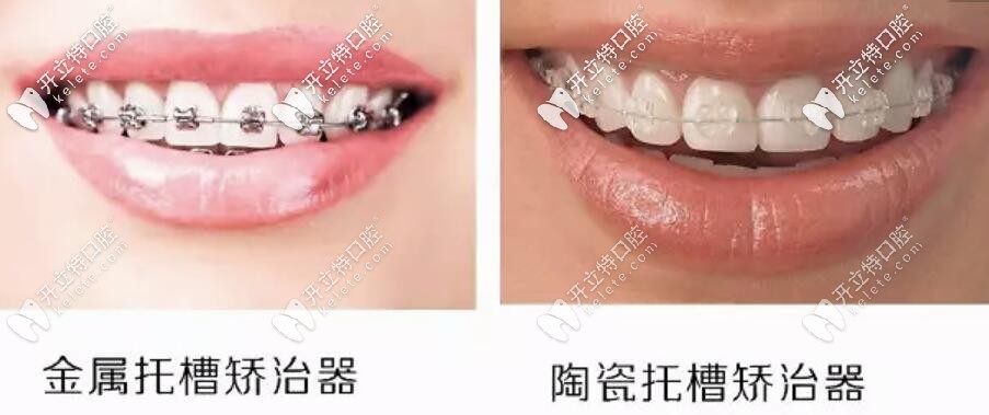 金屬托槽和陶瓷托槽對(duì)比