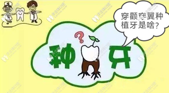 關(guān)于穿顴穿翼板種植牙技術(shù)的風險和效果,你了解多少