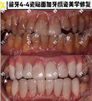 北京雅醫(yī)家口腔瓷貼面真人案例