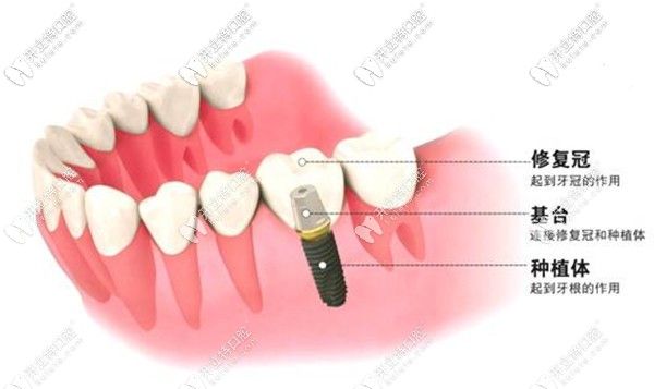 缺一顆牙可以做種植牙修復(fù)