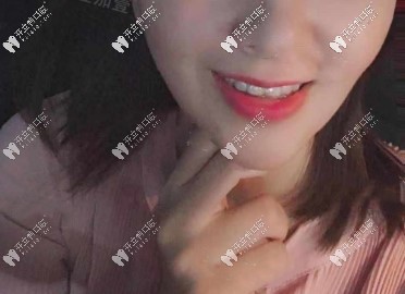 我戴隱適美牙套矯正齙牙280天效果