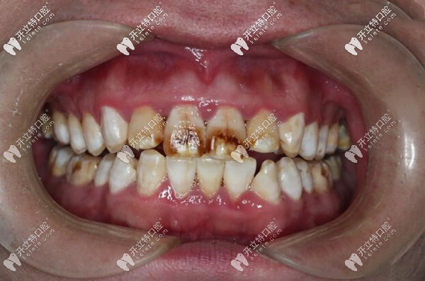 我的重度氟斑牙清晰圖片