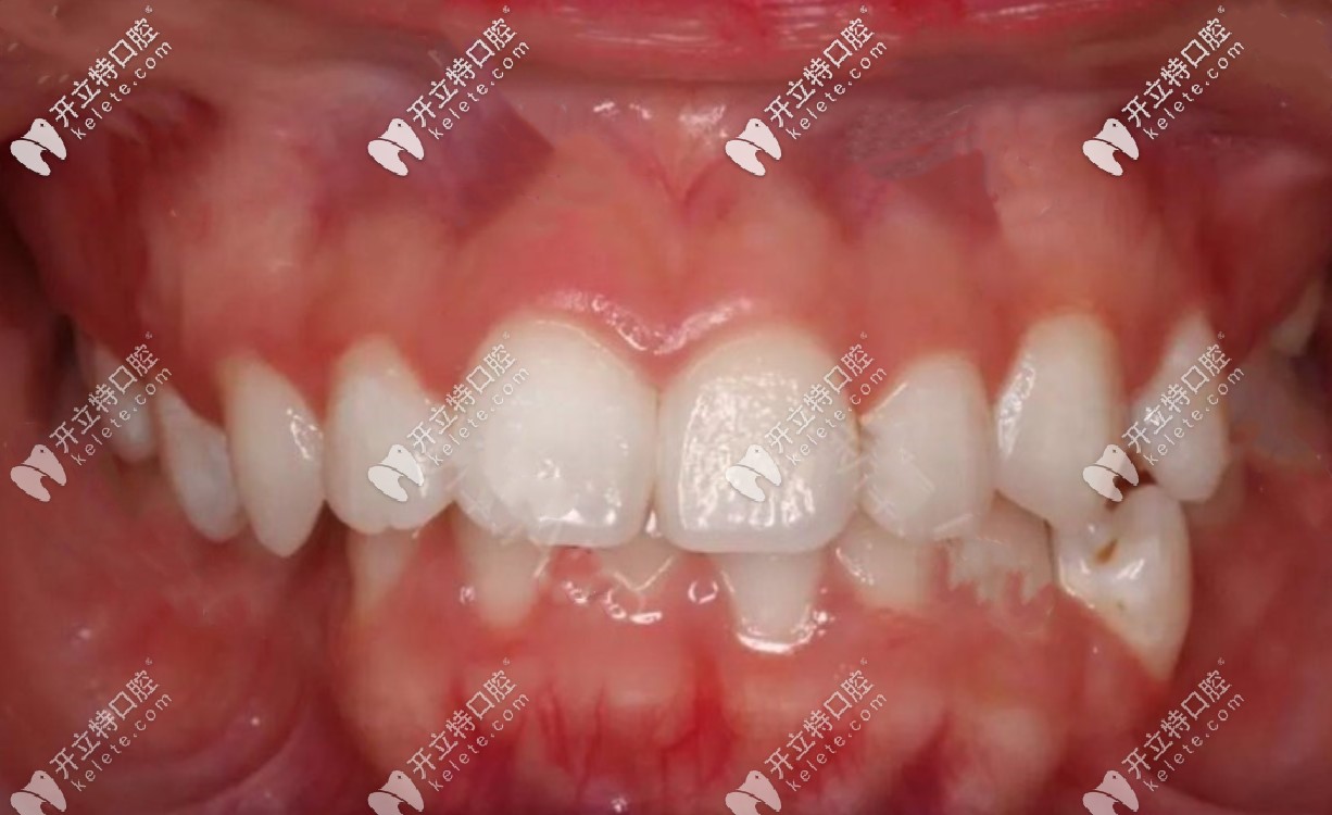 矯正前牙齒照片