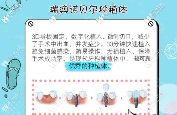 瑞典諾貝爾種植體