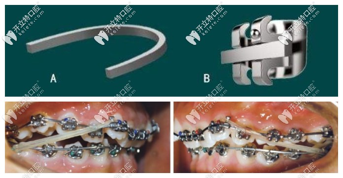 帶狀弓矯治技術(shù)是啥
