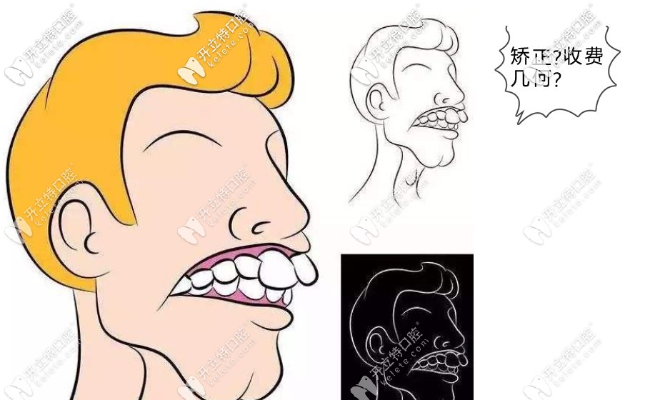 福州矯正牙套價目表里少不了隱適美和鋼牙矯正器收費標準