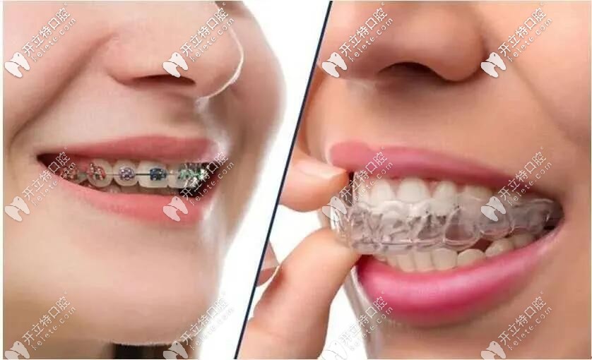 帶了鋼絲牙套后悔的人,快來(lái)看這隱形透明牙套多少錢