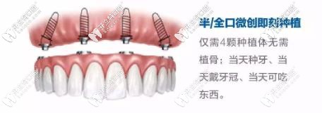 半口即刻種植牙