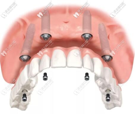All-on-4半口種植牙 