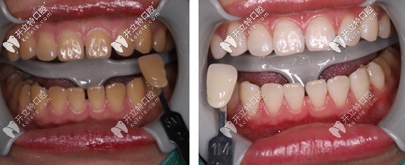 做完一個療程的冷光美白，牙齒色號由5M贈白到1M