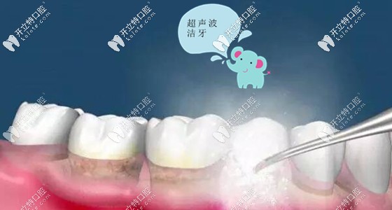 在三亞市洗牙要多少錢(qián)呢