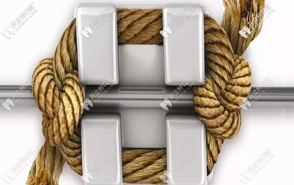 三亞微笑牙科金屬自鎖托槽矯正價(jià)格