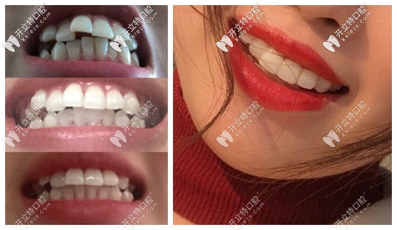 小姐姐使用笑盈隱形牙套矯正三個月的變化已經(jīng)肉眼可見
