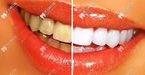 楊哲醫(yī)生介紹瓷貼面修復(fù)的特色