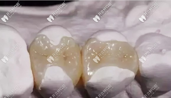 楊哲醫(yī)生對瓷嵌體修復(fù)的介紹