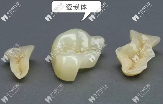 在三亞的補(bǔ)牙收費(fèi)參考價(jià)格