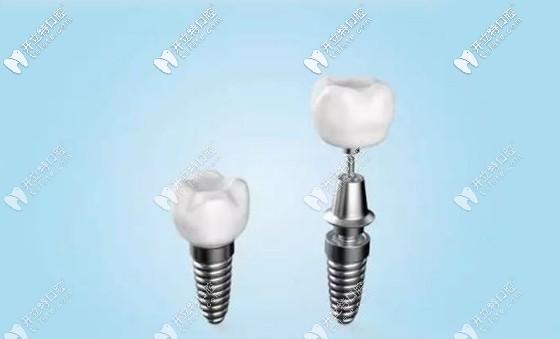 三亞正規(guī)牙科醫(yī)院種植牙參考價(jià)格