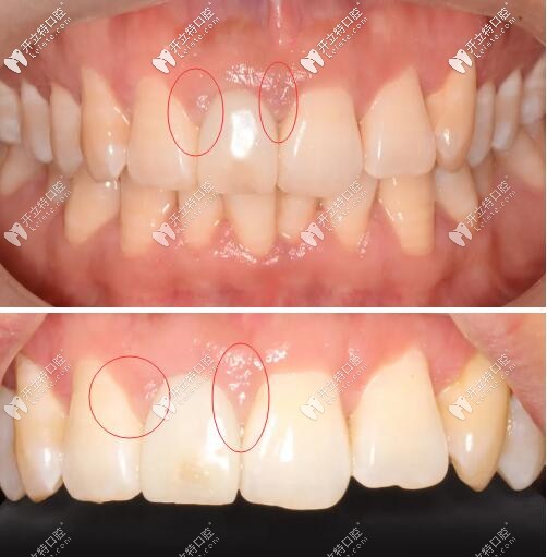 過渡義齒修復齦乳頭變化