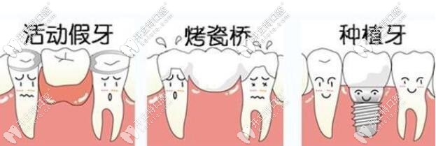 牙齒缺失修復方式