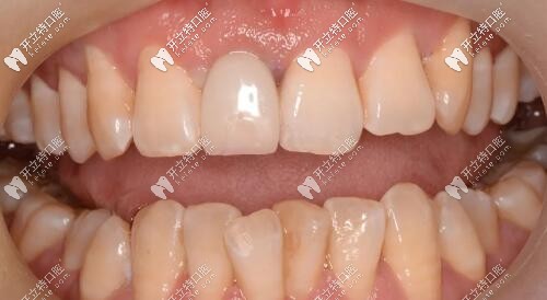 門牙外傷過渡義齒修復