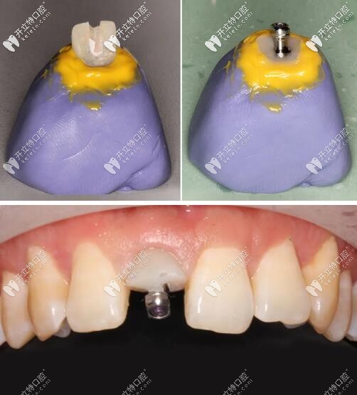 種植牙佩戴轉(zhuǎn)移桿