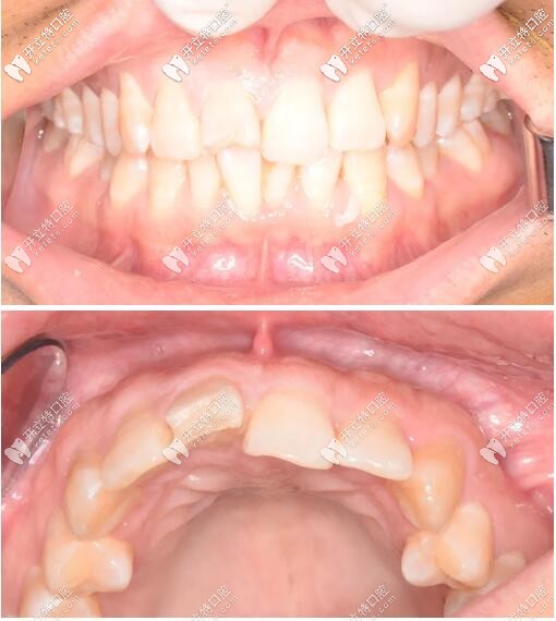 一例門牙外傷松動修復案例