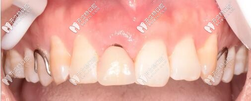 活動義齒修復門牙 