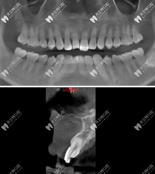 門牙磕斷傷及牙根影像學檢查