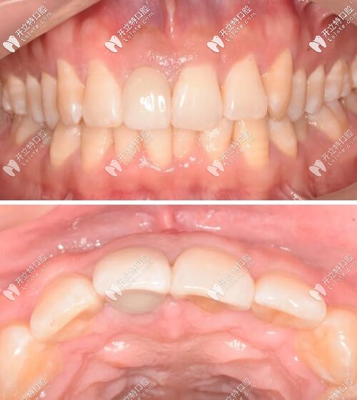 門牙瑞士iti鈦親水4.1mm*10mmBL種植體修復案例