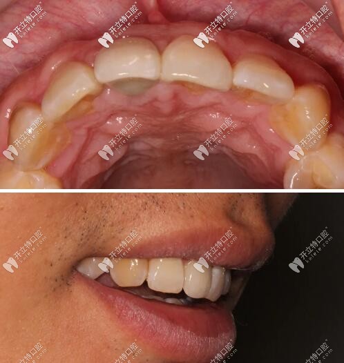 門牙磕傷瑞士iti種牙修復1年后