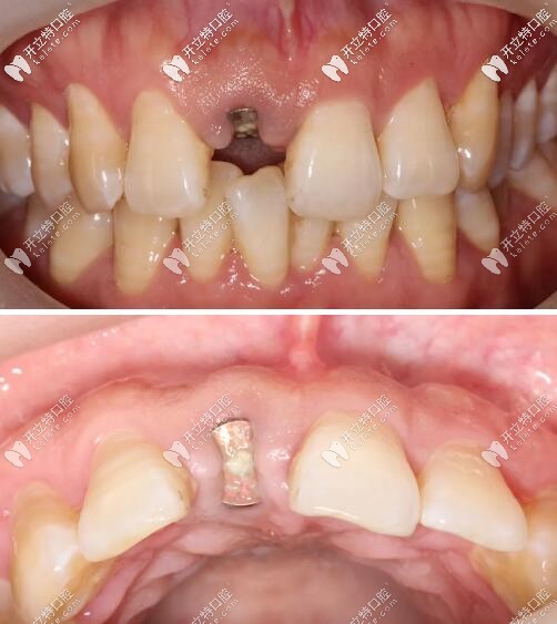 門牙外傷即刻種植牙三個月后