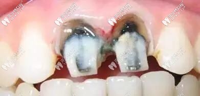 烤瓷牙黑線問(wèn)題