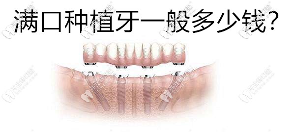 才二十歲就烤瓷了17顆牙,想換滿口牙種植一般多少錢？
