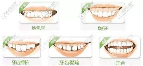 哪些人適合做隱形矯正？