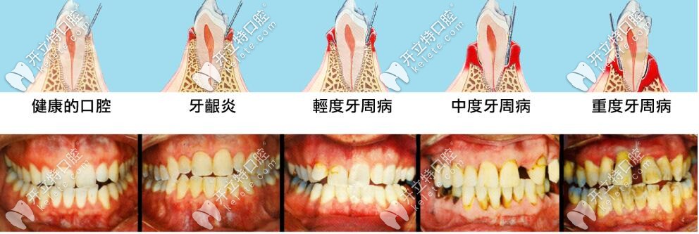 牙周病發(fā)展過(guò)程
