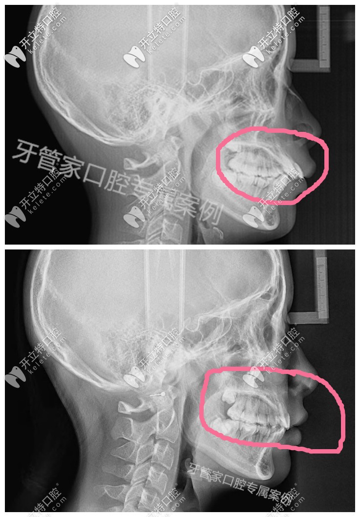 骨性齙牙帶牙套有效果，下牙套后我的骨性牙齒內(nèi)收了6毫米