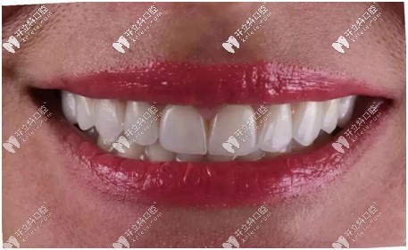 e-max貼面口腔效果圖