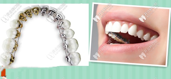 關(guān)于舌側(cè)矯正的價(jià)格貴于唇側(cè)矯正的原因