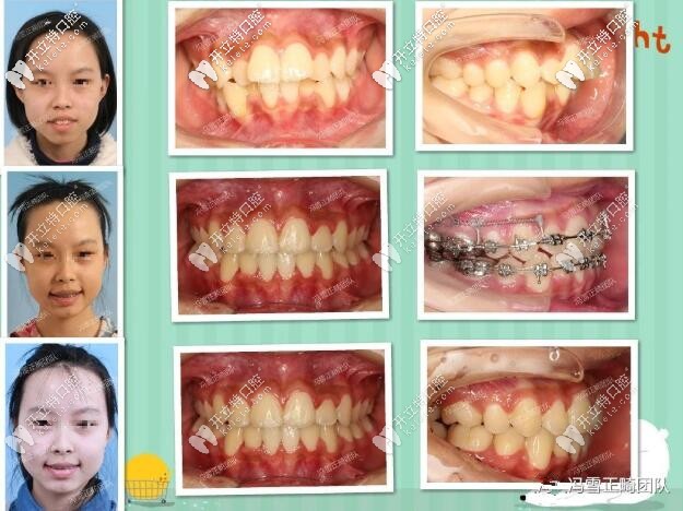 西安美奧口腔門診部?jī)和例X矯正案例