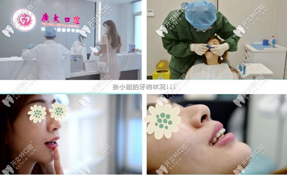 關(guān)于舌側(cè)矯正和唇側(cè)矯正的區(qū)別