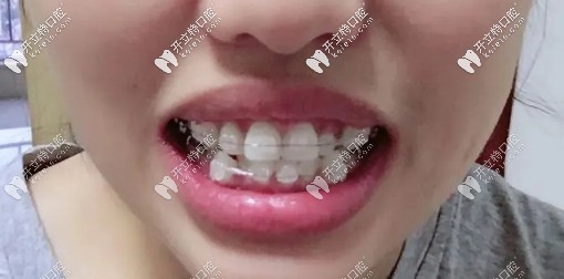 戴陶瓷自鎖托槽中期，牙齒已經(jīng)開始慢慢歸位